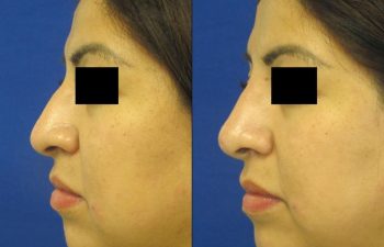 Female Patient Before & After Non Surgical Rhinoplasty