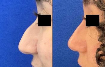 Female Patient Before & After Non Surgical Rhinoplasty