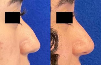 Female Patient Before & After Non Surgical Rhinoplasty