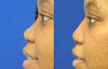 Female Patient Before & After Non Surgical Rhinoplasty