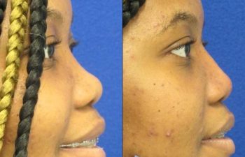 Female Patient Before & After Non Surgical Rhinoplasty