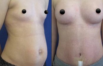 Female Patient Before & After Tummy Tuck