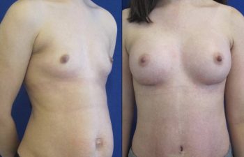 Female Patient Before & After Breast Augmentation