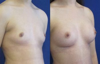 Female Patient Before & After Breast Augmentation