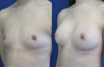 Female Patient Before & After Breast Augmentation