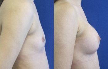 Female Patient Before & After Breast Augmentation