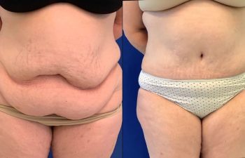 Female Patient Before & After Tummy Tuck