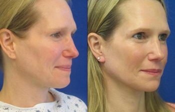 Female Patient Before & After Mini FaceLift