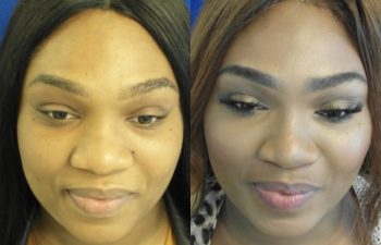 Female Patient Before & After Nostril Reduction