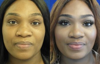 Female Patient Before & After Nostril Reduction