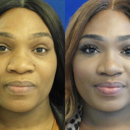 Female Patient Before & After Nostril Reduction