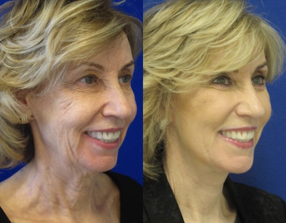 Female Patient Before & After FaceLift