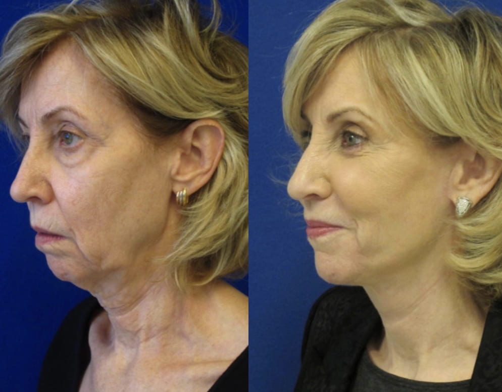 Female Patient Before & After FaceLift