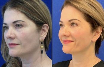 Female Patient Before & After Mini FaceLift