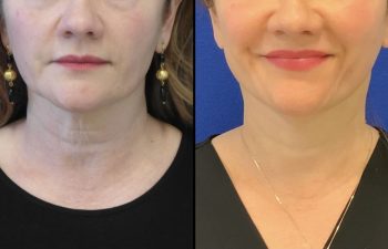 Female Patient Before & After Mini FaceLift