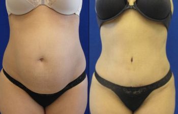 Female Patient Before & After Liposuction