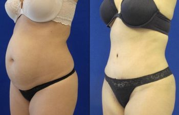 Female Patient Before & After Liposuction