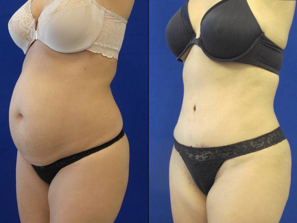 Female Patient Before & After Liposuction