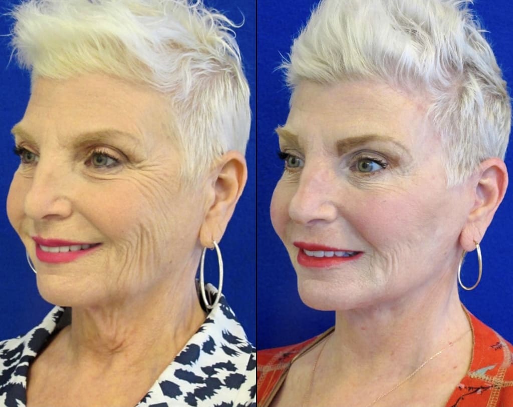 Female Patient Before & After FaceLift
