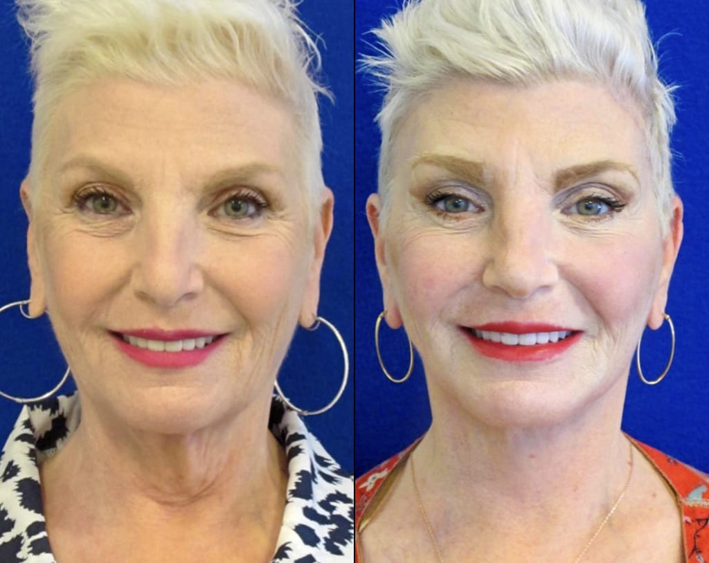 Female Patient Before & After FaceLift