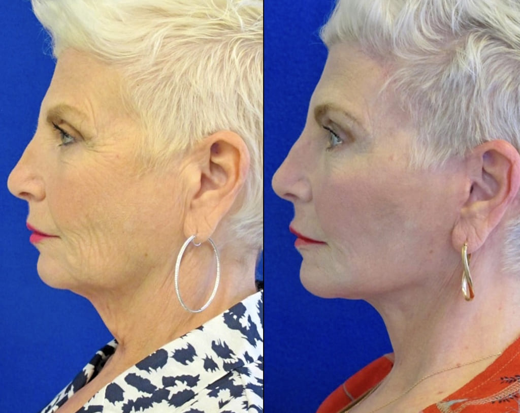 Female Patient Before & After FaceLift
