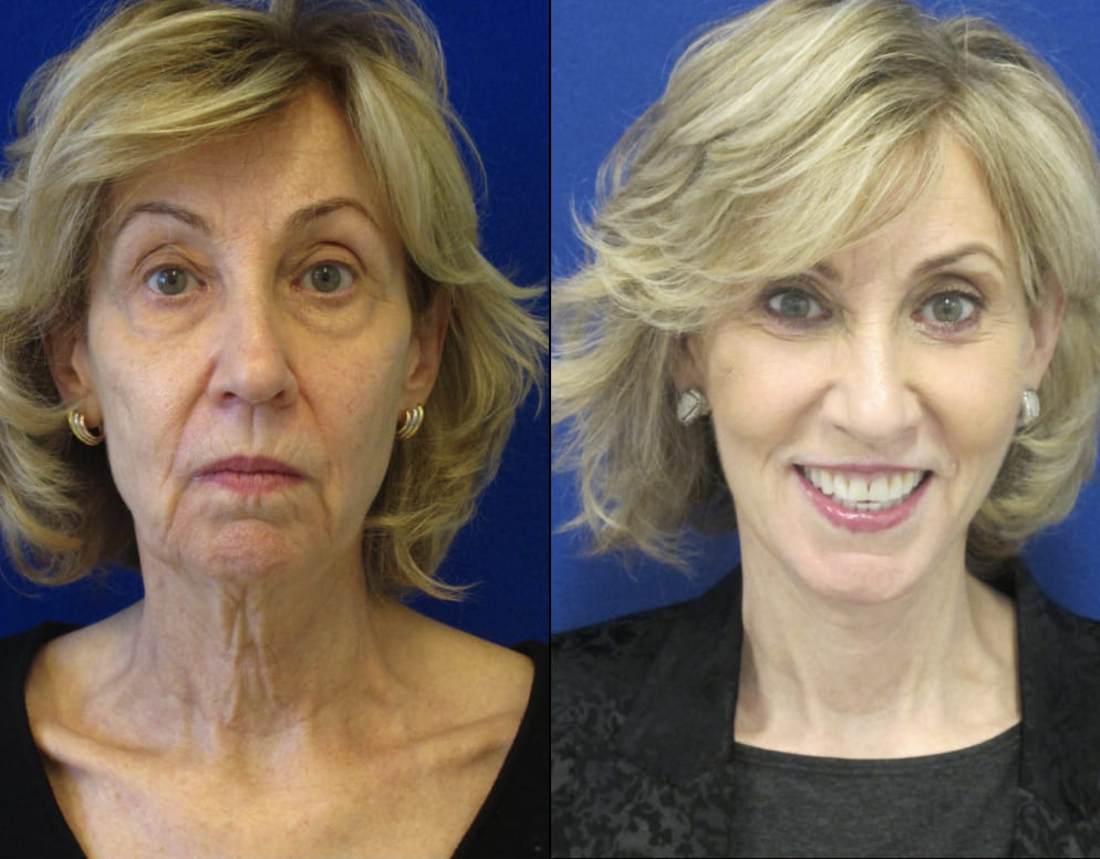 Female Patient Before & After FaceLift