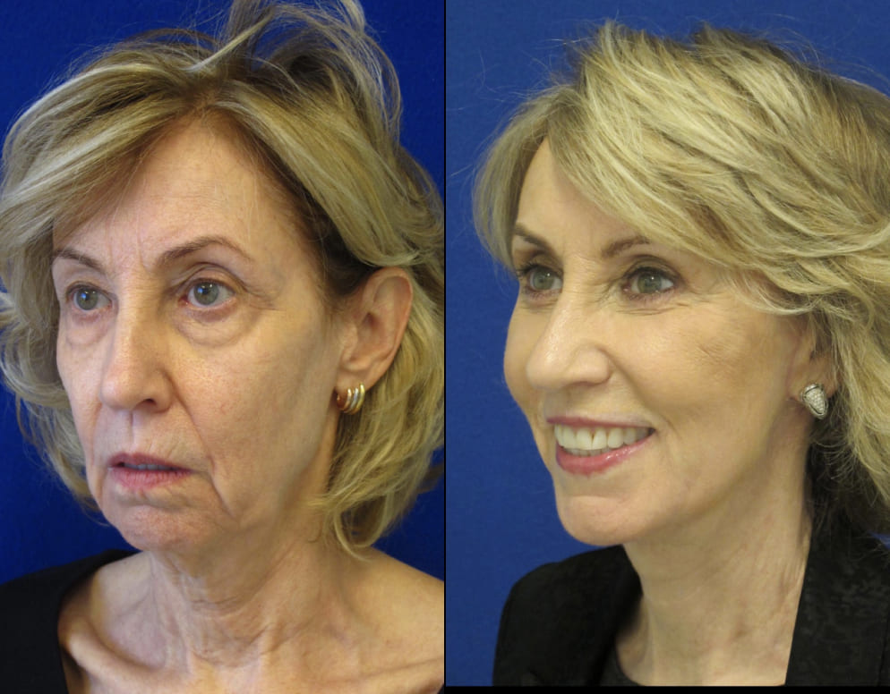Female Patient Before & After FaceLift