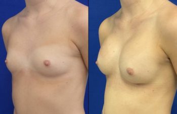 Female Patient Before & After Breast Augmentation