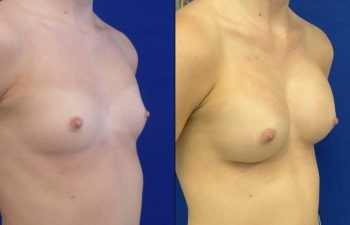 Female Patient Before & After Breast Augmentation