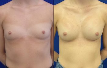 Female Patient Before & After Breast Augmentation