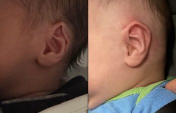 Young Patient Before & After Ear Shaping