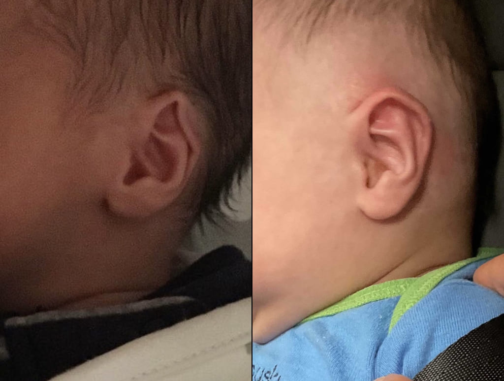 Young Patient Before & After Ear Shaping
