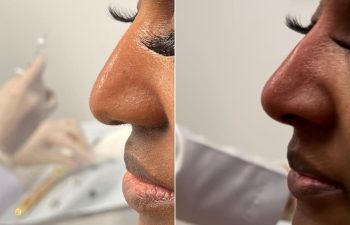 Female Patient Before & After Non Surgical Rhinoplasty