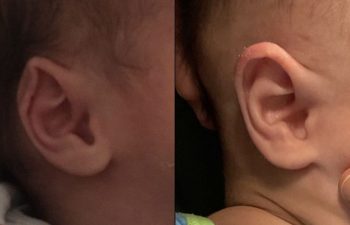 Young Patient Before & After Ear Shaping