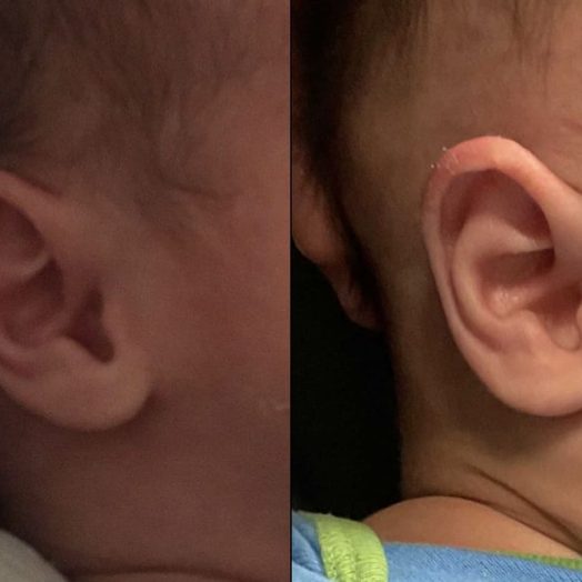 Young Patient Before & After Ear Shaping