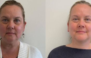 Female Patient Before & After Mini Facelift