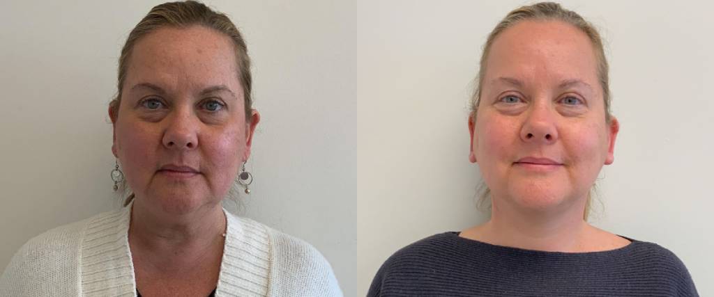 Female Patient Before & After Mini Facelift