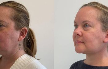 Female Patient Before & After Mini Facelift