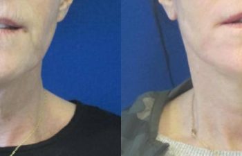 Female Patient Before & After FaceLift