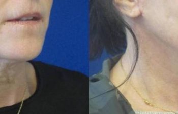 Female Patient Before & After FaceLift