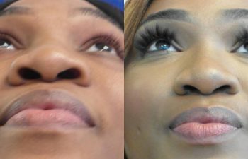 Female Patient Before & After Nostril Reduction