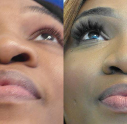 Female Patient Before & After Nostril Reduction