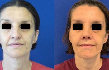 Female Patient Before & After Rhinoplasty