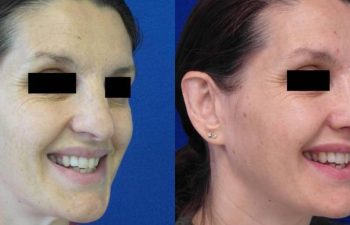 Female Patient Before & After Rhinoplasty