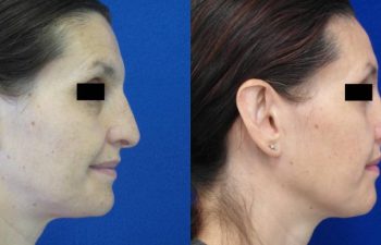 Female Patient Before & After Rhinoplasty