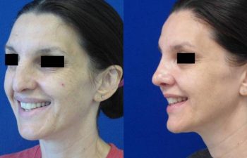 Female Patient Before & After Rhinoplasty