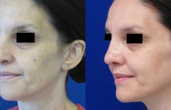 Female Patient Before & After Rhinoplasty