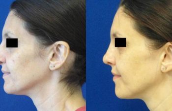 Female Patient Before & After Rhinoplasty