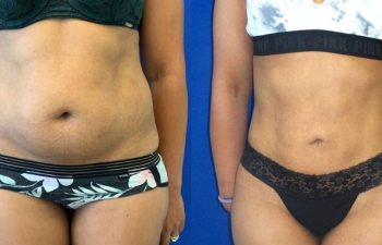 Female Patient Before & After Liposuction