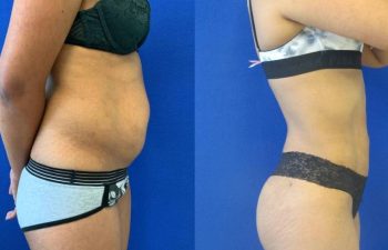 Female Patient Before & After Liposuction